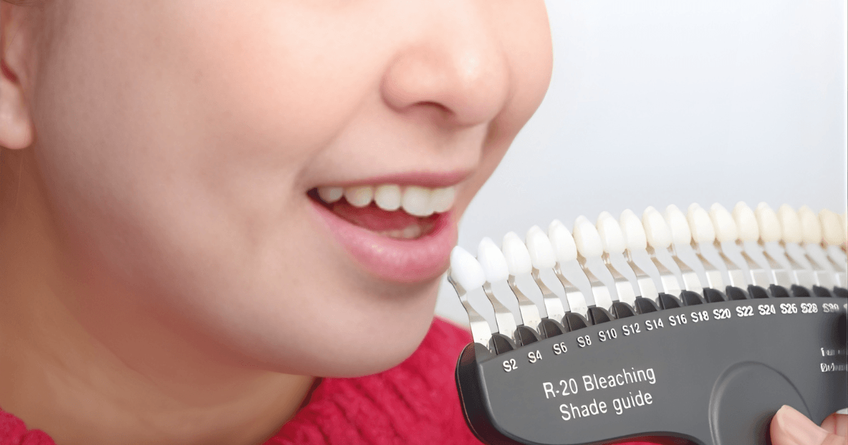 前歯　審美治療　選ぶ　ポイント