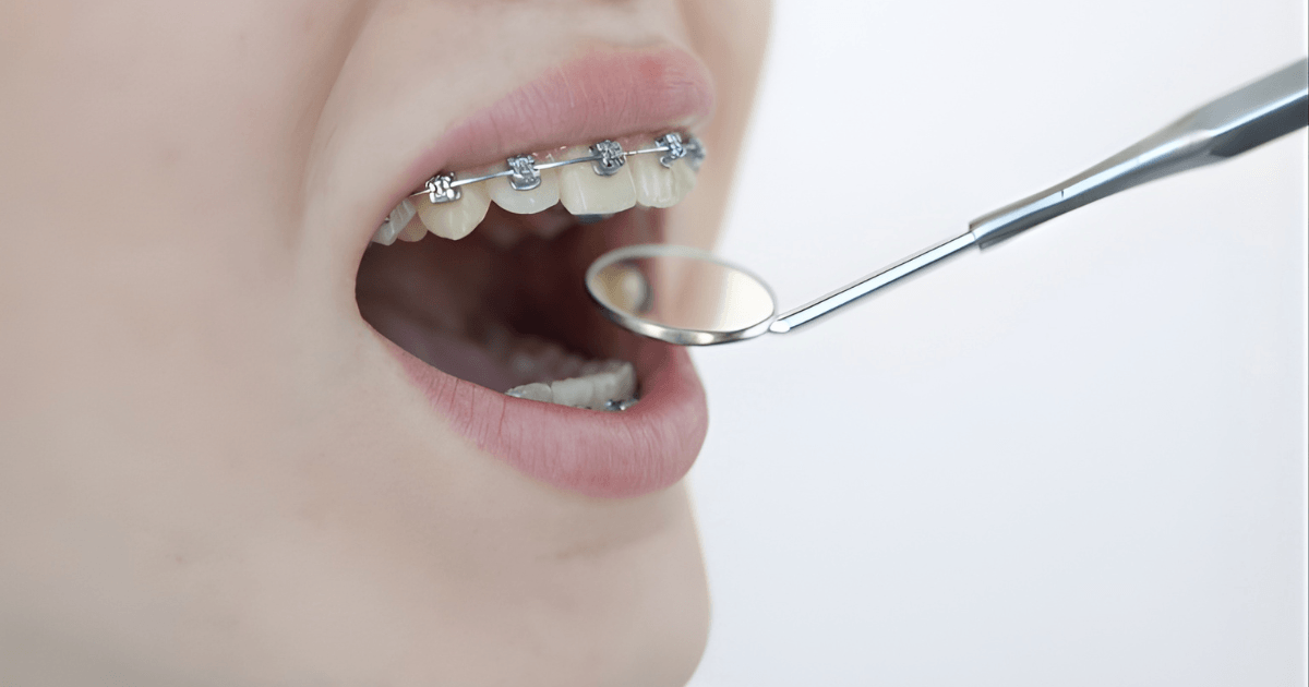 審美歯科　矯正歯科　違い