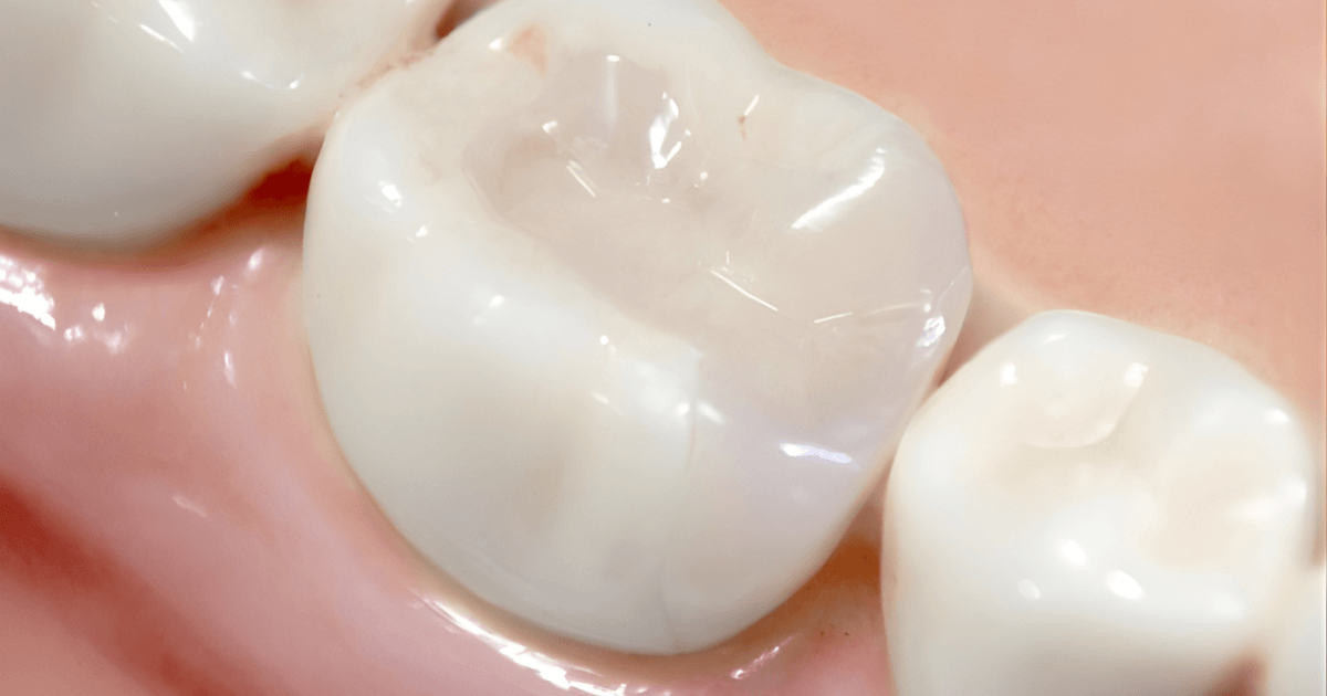 審美歯科　セラミック治療