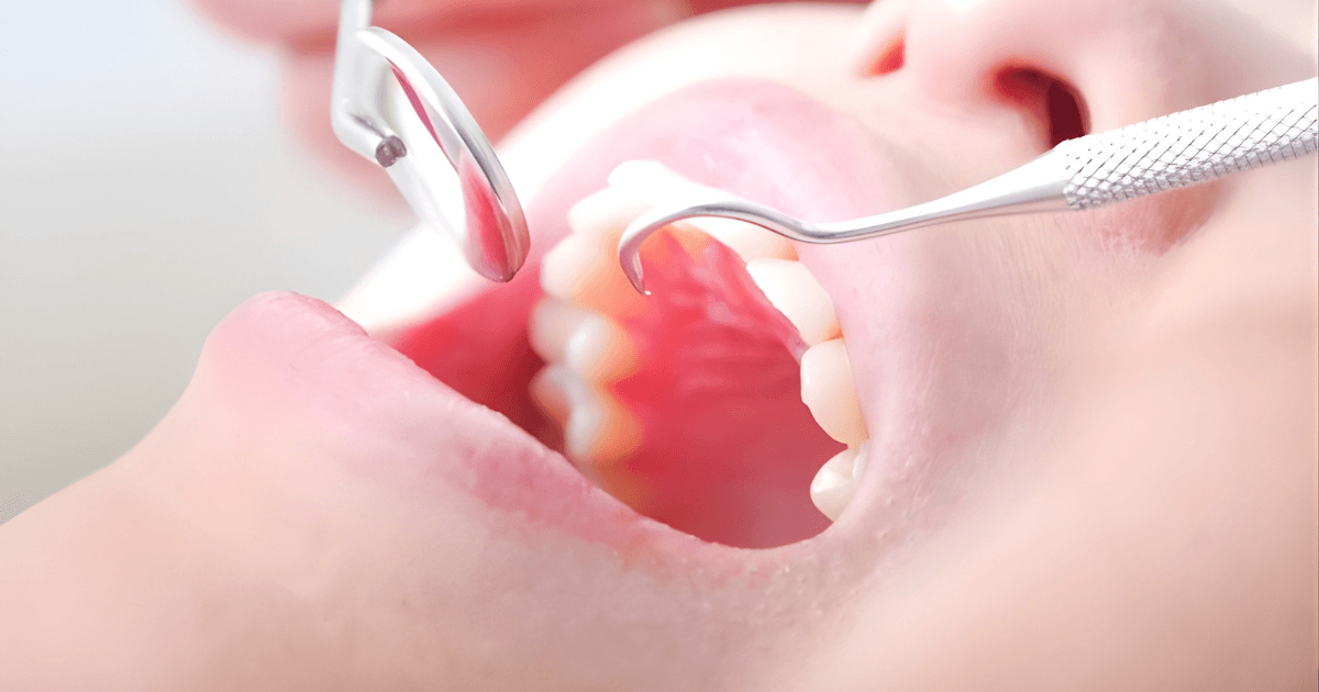 審美歯科　セラミック　種類