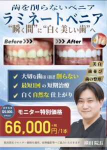 【4月スタート】歯を削らない「ラミネートベニア」特別モニター募集のお知らせ