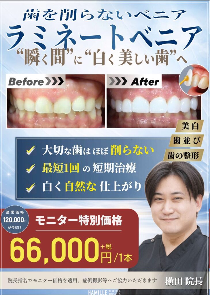 【4月スタート】歯を削らない「ラミネートベニア」特別モニター募集のお知らせ